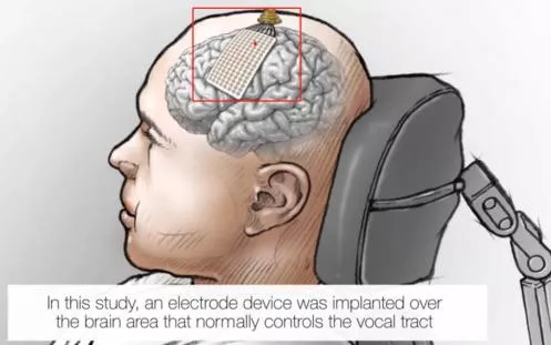 从脑瘫患者重获交流到免开颅微创，脑机接口更安全了吗？