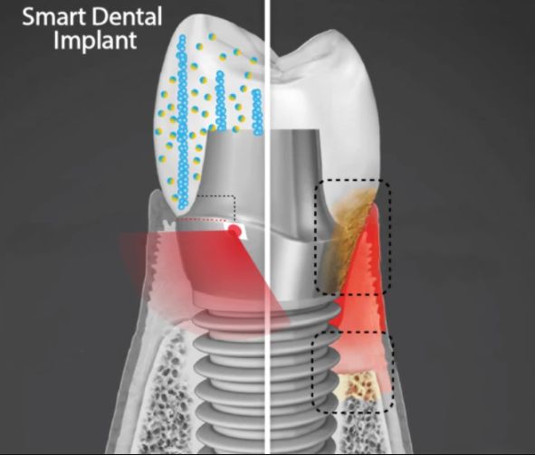科学家开发牙科植入物 可通过发电治愈感染的牙龈