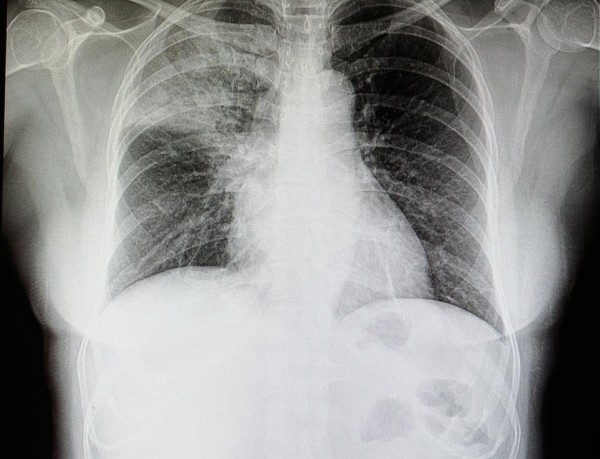 新冠肺炎肺部x光片图片